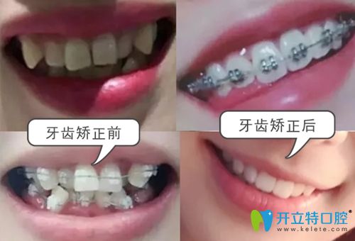珠海九龍口腔牙齒矯正前后效果對比圖