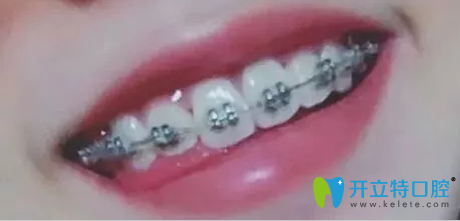 珠海九龍口腔做金屬牙套矯正一年效果圖 珠海九龍口腔做金屬牙套矯正一年效果圖
