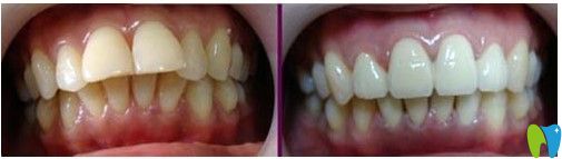 廣州壹加壹口腔齙牙矯治案例圖