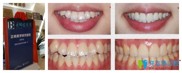 好佰年口腔正畸藍(lán)皮書(shū)和案例