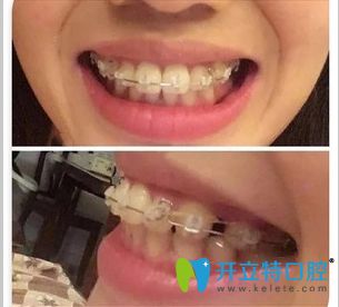 東莞壹加壹口腔牙齒矯正半年效果圖 東莞壹加壹口腔牙齒矯正半年效果圖