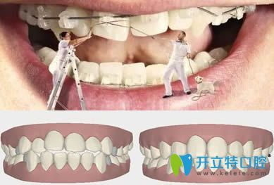 巫強平主任科普成人正畸與兒童正畸有什么區(qū)別 巫強平主任科普成人正畸與兒童正畸有什么區(qū)別