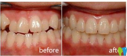 北京維樂(lè)口腔牙齒不齊矯正案例圖