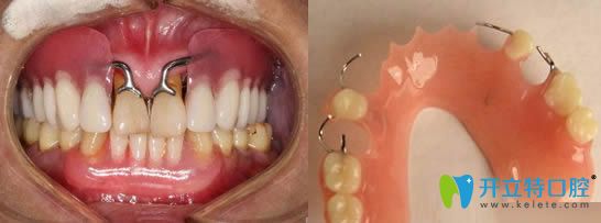 桂洪萍科普活動(dòng)義齒修復(fù)的優(yōu)缺點(diǎn) 桂洪萍科普活動(dòng)義齒修復(fù)的優(yōu)缺點(diǎn)