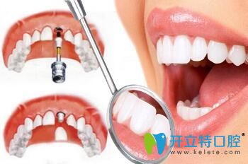 昆明尚愛韓美口腔陸成華介紹種植牙術(shù)后注意事項(xiàng)