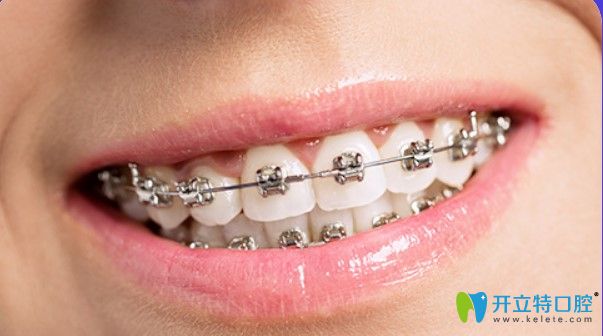 北京維樂(lè)口腔金屬托槽矯正