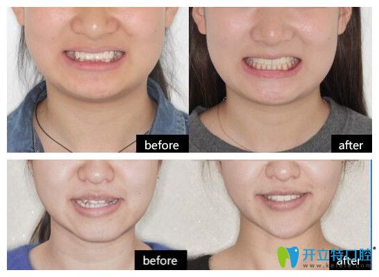 維樂(lè)口腔的正畸案例前后效果對(duì)比圖