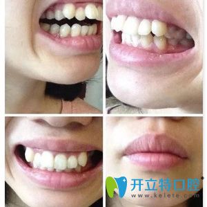 記錄我在東莞壹加壹口腔花1萬(wàn)多做的陶瓷隱形牙齒矯正體驗(yàn)