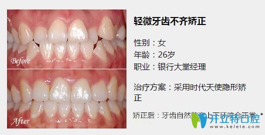 惠州致美口腔時(shí)代天使隱形矯正案例