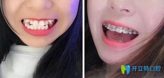 東莞壹加壹口腔牙齒正畸前后效果對比圖 東莞壹加壹口腔牙齒正畸前后效果對比圖
