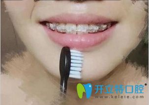 在東莞壹加壹口腔做陶瓷托槽矯正牙齒11個月效果 在東莞壹加壹口腔做陶瓷托槽矯正牙齒11個月效果