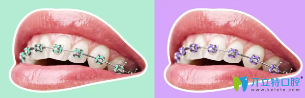 成都圣貝炫彩金屬牙齒矯正