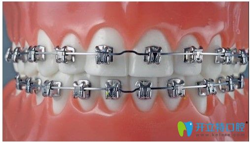 福州維樂口腔金屬自鎖矯正圖