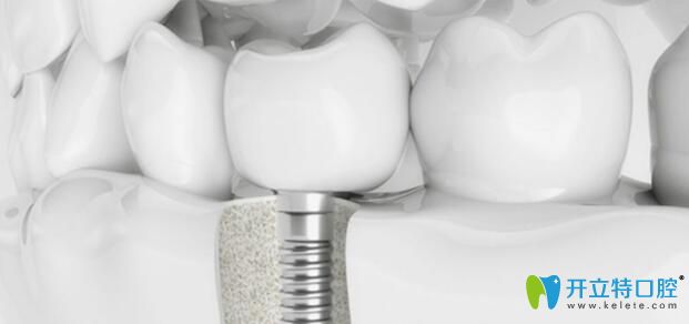 老爸在南昌輝煌口腔做ALL-ON-4/6全口種植牙當天就能吃東西啦