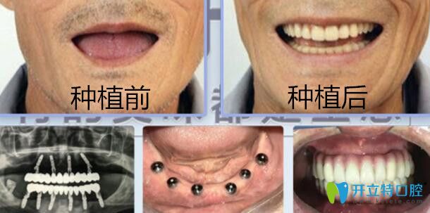 老爸在南昌輝煌口腔做全口種植前后照片 老爸在南昌輝煌口腔做全口種植前后照片