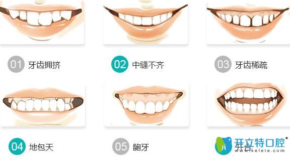 南昌輝煌口腔謝俊醫(yī)生介紹牙齒矯正吃東西禁忌 南昌輝煌口腔謝俊醫(yī)生介紹牙齒矯正吃東西禁忌