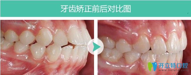 福州維樂口腔齙牙矯正圖