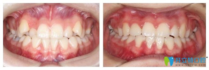 青島維樂口腔虎牙矯正圖