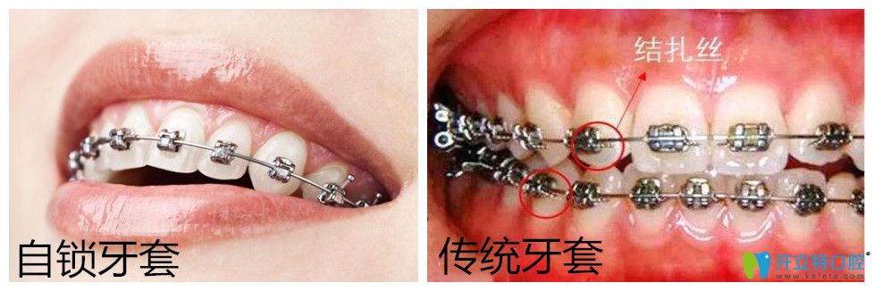 自鎖托槽牙齒矯正多少錢？正畸國(guó)產(chǎn)與進(jìn)口自鎖有區(qū)別嗎?