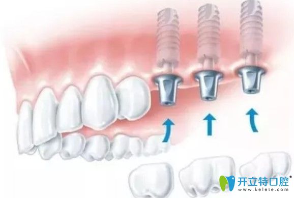 維樂口腔種植體和牙冠的銜接圖