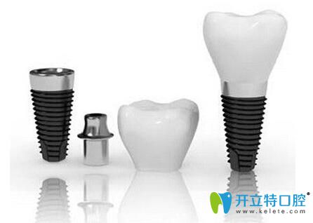 昆明尚愛韓美口腔李滿坡醫(yī)生介紹種植牙