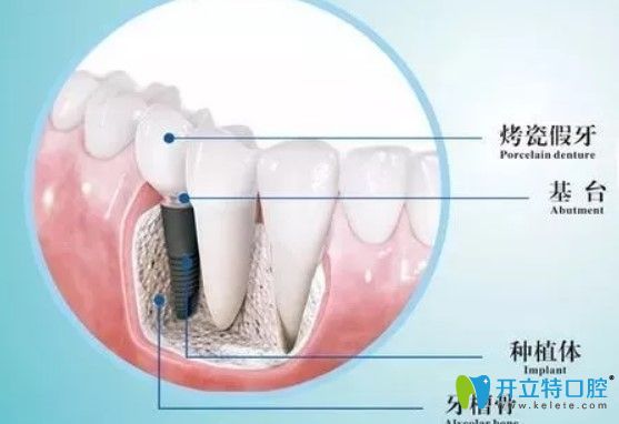 維樂口腔種植牙是由基臺、種植體組成圖示