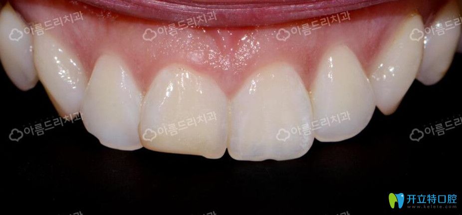 韓國(guó)安特麗做牙貼面前牙齒情況 韓國(guó)安特麗做牙貼面前牙齒情況