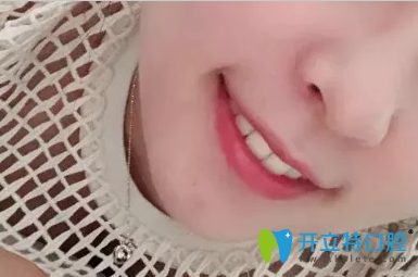 牙齒矯正可以做兩次，正畸效果是美好的