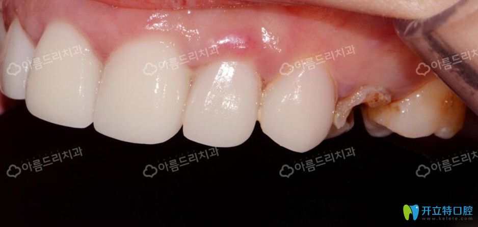 去韓國(guó)安特麗做后牙種植前 去韓國(guó)安特麗做后牙種植前