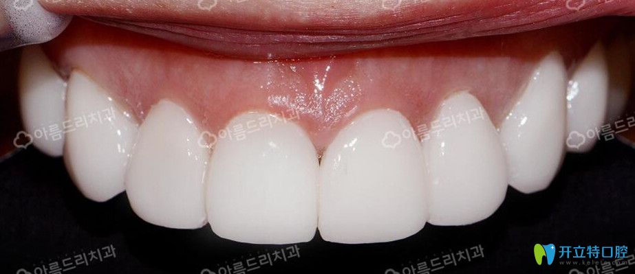 韓國(guó)安特麗牙貼面后效果圖 韓國(guó)安特麗牙貼面后效果圖