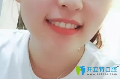 做第二次牙齒矯正后的效果圖