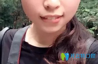 用我第二次牙齒正畸的效果來回答牙齒矯正可以做兩次嗎