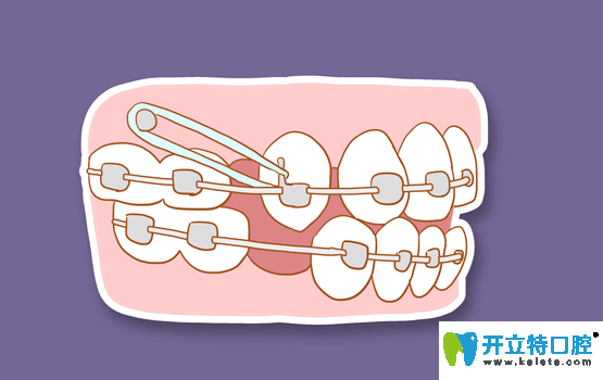 寧波恒美口腔王金總監(jiān)的正畸優(yōu)勢