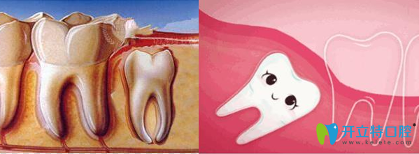 科普：埋伏牙與阻生牙的區(qū)別以及全埋伏牙沒癥狀要不要拔