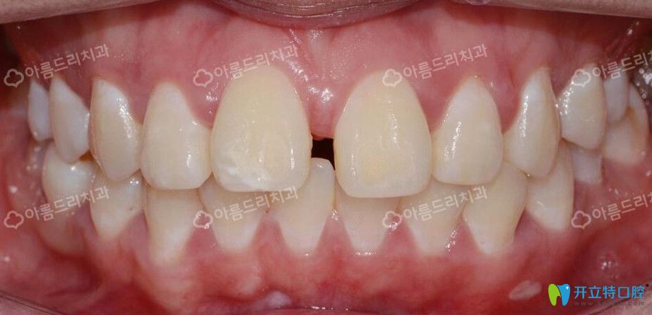 韓國牙科水平怎么樣?安特麗牙科種植矯正案例及評價供參考