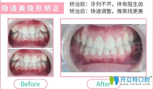 濟(jì)南韓氏口腔隱形牙齒矯正效果 濟(jì)南韓氏口腔隱形牙齒矯正效果