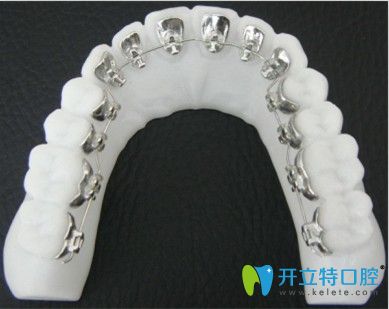 南昌輝煌口腔丁圣剛介紹舌側(cè)牙齒矯正技術(shù)優(yōu)勢(shì) 南昌輝煌口腔丁圣剛介紹舌側(cè)牙齒矯正技術(shù)優(yōu)勢(shì)