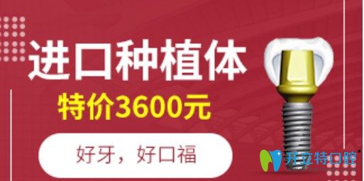 深圳正夫進口種植牙優(yōu)惠價格