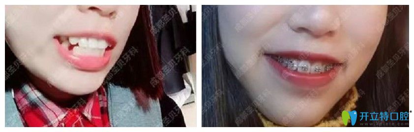 圣貝口腔齙牙矯正案例圖示