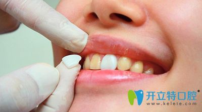 南昌輝煌口腔胡瑞雪科普牙齒貼面后注意事項 南昌輝煌口腔胡瑞雪科普牙齒貼面后注意事項