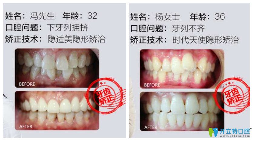 德韓口腔牙齒矯正案例前后效果對比圖