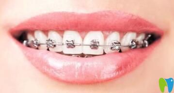 南昌輝煌口腔劉梅分享自鎖托槽牙齒矯正優(yōu)勢(shì) 南昌輝煌口腔劉梅分享自鎖托槽牙齒矯正優(yōu)勢(shì)