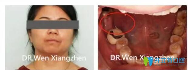 震驚！林阿姨在湖州鼎植口腔做了一顆種植牙價格才2500元