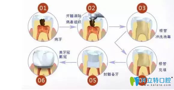 南昌輝煌口腔彭凡主任科普牙齒根管治療注意事項 南昌輝煌口腔彭凡主任科普牙齒根管治療注意事項