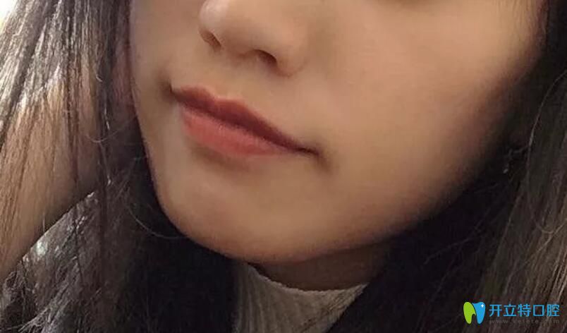 牙齒矯正過程中正面圖