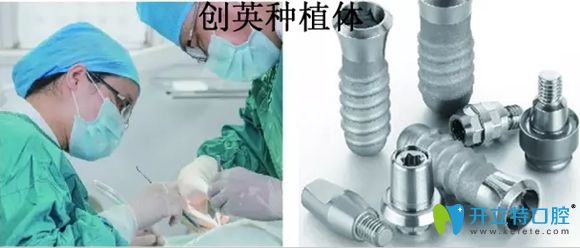 國產(chǎn)創(chuàng)英種植體怎么樣,創(chuàng)英與進口4級純鈦種植牙的區(qū)別是啥