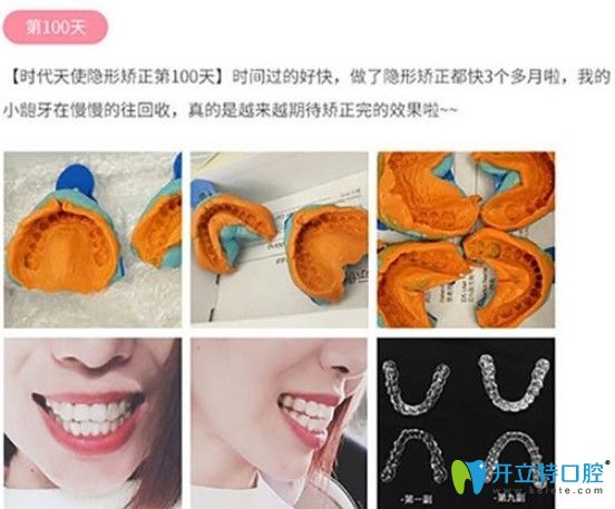 唯美口腔顧客戴時(shí)代天使隱形牙套100天圖示