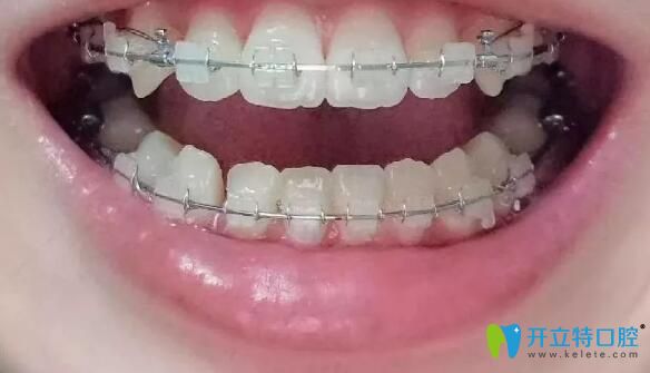 我在廣州柏德口腔戴半隱形牙套9個(gè)月