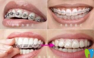 昆明尚愛韓美口腔許敬醫(yī)生分享做牙齒矯正期間的注意事項