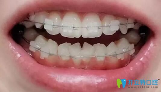 我在廣州柏德口腔做牙齒矯正第6個(gè)月